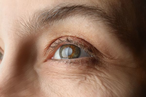 Tratamiento de Cataratas en VisionkerClinic